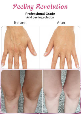 สูตรกรองมืออาชีพสําหรับการเปลือกผิวหน้า