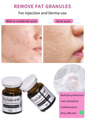Stalidearm Dermal Fillers รักษาสิว สารสับฉีดเพื่อรักษาสิวและลดจุดบกพร่อง