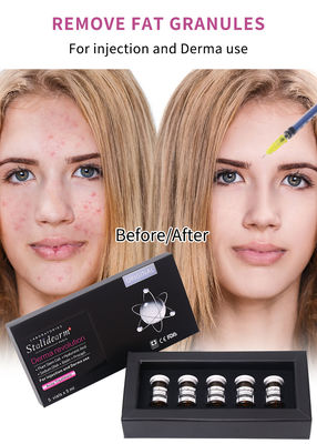Stalidearm Dermal Fillers รักษาสิว สารสับฉีดเพื่อรักษาสิวและลดจุดบกพร่อง