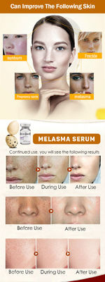 Skincare Meso Serum Microneedling Removal Freckle Serum Melasma Skin Whitening