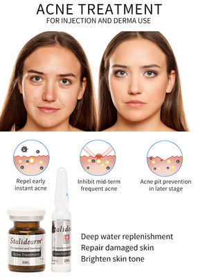 Stalidearm Acne Treatment เซรั่มฉีด Mesotherapy บำรุงไม่มีผลข้างเคียง